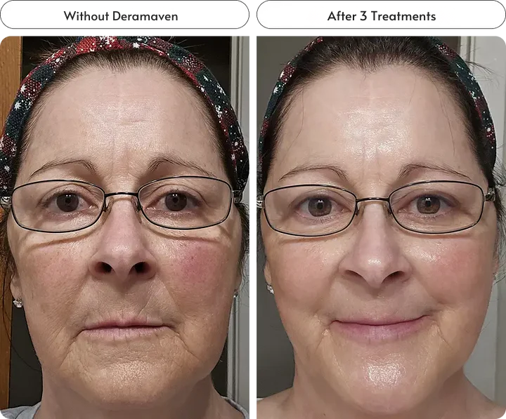 Minimize Fine Lines & Wrinkles