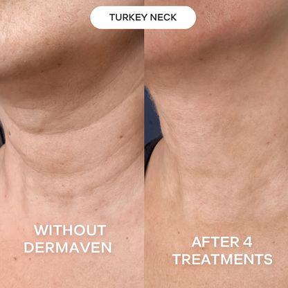 Deramaven Micro-Infusion System